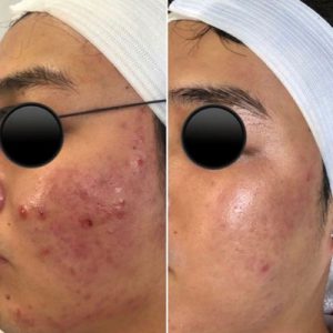 Aerolase NeoClear Laser