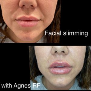 Agnes RF - Facial Slimming