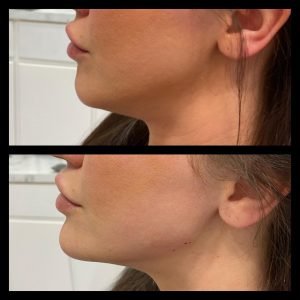 Chin Filler