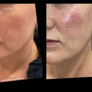 Juvederm - Cheek Filler