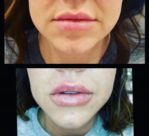 Lip Filler + Agnes Facial Sculpting