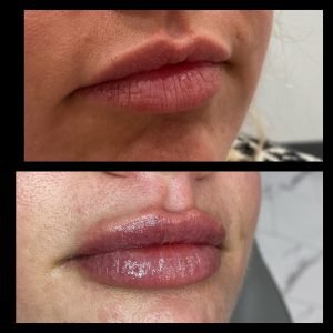 Lip Filler