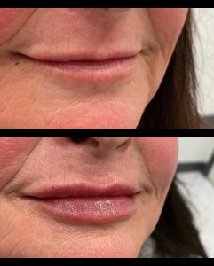 Lip Filler