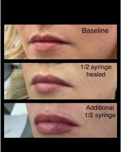 Lip Filler