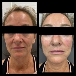 Plasma Gel