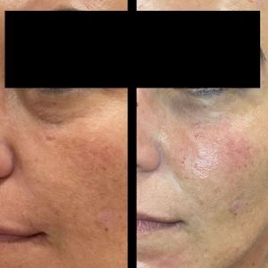 Under Eye Filler
