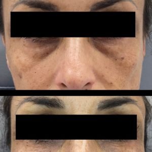 PRF + Versa Under Eyes