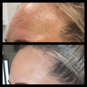 Botox