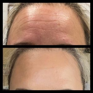 Botox