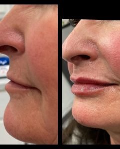 Lip Filler