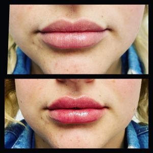 Lip Filler