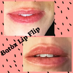 Botox Lip Flip