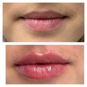 Lip Filler