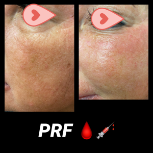 PRF