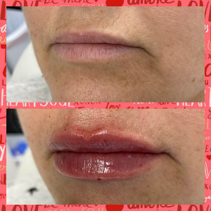 Lip Filler