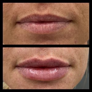 Lip Filler