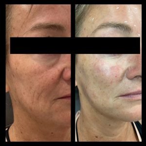 Cheek Filler