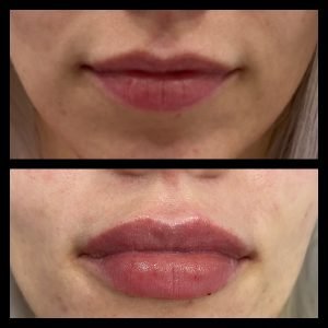 Lip Filler