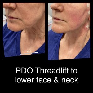 PDO Threadlift to Lower Face and Neck