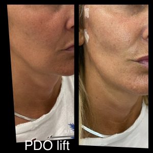 PDO Lift